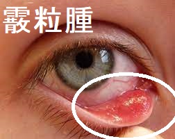 霰粒腫1 霰粒腫1