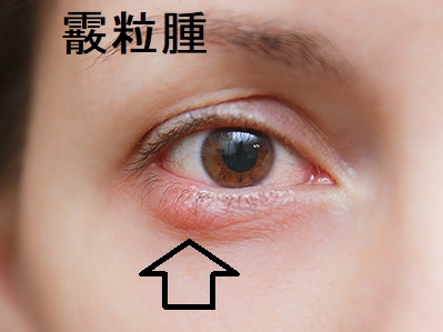 霰粒腫2 霰粒腫2