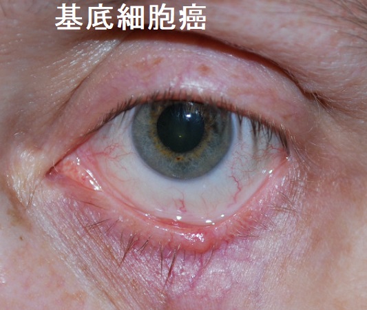 基底細胞癌 基底細胞癌