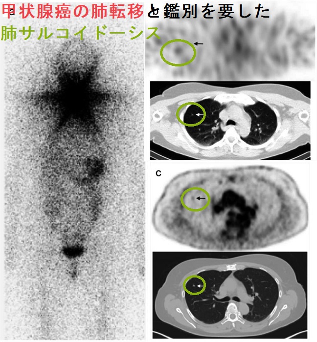 甲状腺癌の肺転移と鑑別を要した肺サルコイドーシス1 甲状腺癌の肺転移と鑑別を要した肺サルコイドーシス1