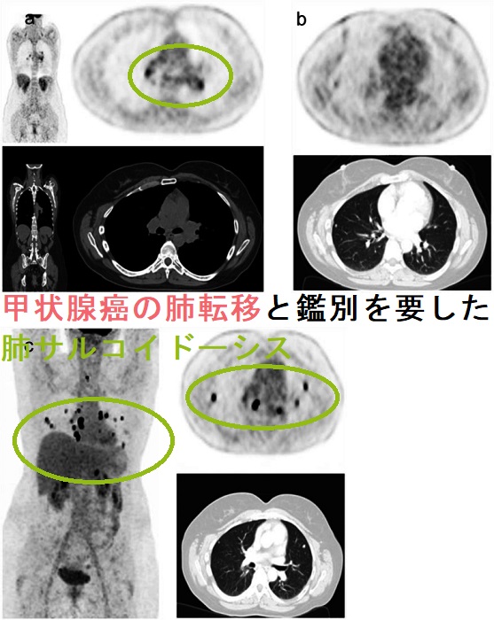 甲状腺癌の肺転移と鑑別を要した肺サルコイドーシス2 甲状腺癌の肺転移と鑑別を要した肺サルコイドーシス2