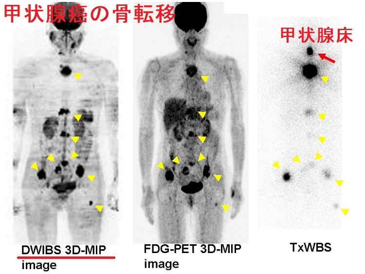 甲状腺癌の骨転移 DWIBS(ドゥイブス) 甲状腺癌の骨転移 DWIBS(ドゥイブス)