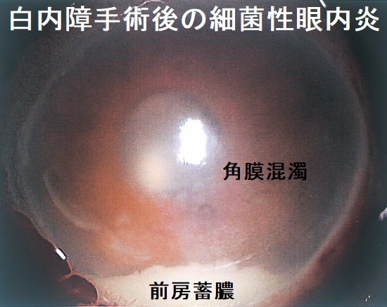 白内障手術後の細菌性眼内炎 白内障手術後の細菌性眼内炎