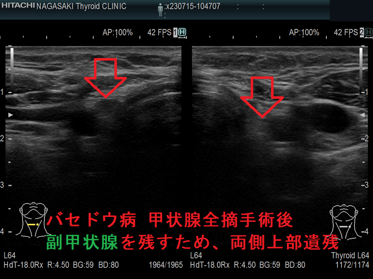 バセドウ病 甲状腺全摘手術後 副甲状腺を残すため両側上部遺残 バセドウ病 甲状腺全摘手術後 副甲状腺を残すため両側上部遺残