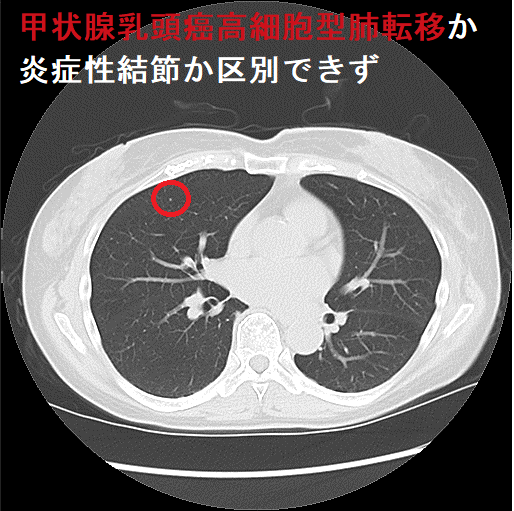 甲状腺乳頭癌高細胞型肺転移か炎症性結節か区別できず(CT画像)2 甲状腺乳頭癌高細胞型肺転移か炎症性結節か区別できず(CT画像)2