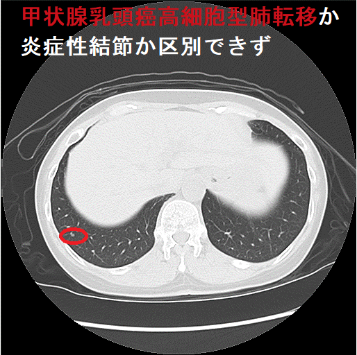 甲状腺乳頭癌高細胞型肺転移か炎症性結節か区別できず(CT画像)1 甲状腺乳頭癌高細胞型肺転移か炎症性結節か区別できず(CT画像)1