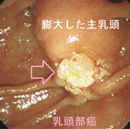 乳頭部癌 乳頭部癌