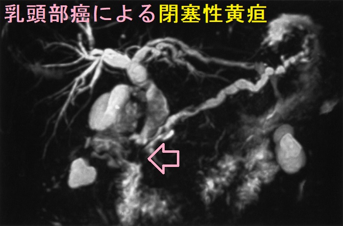 乳頭部癌による閉塞性黄疸 乳頭部癌による閉塞性黄疸