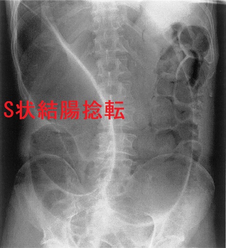 S状結腸捻転 S状結腸捻転