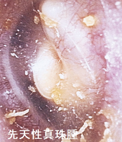 先天性真珠腫 先天性真珠腫