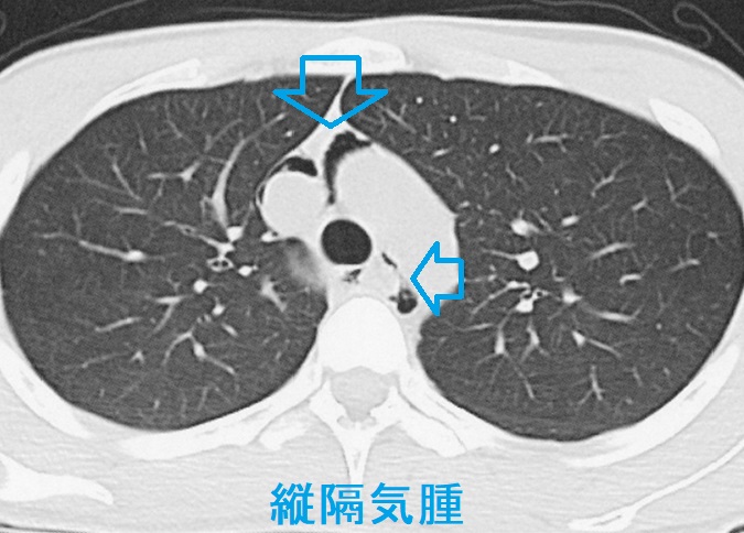 縦隔気腫 CT画像2 縦隔気腫 CT画像2