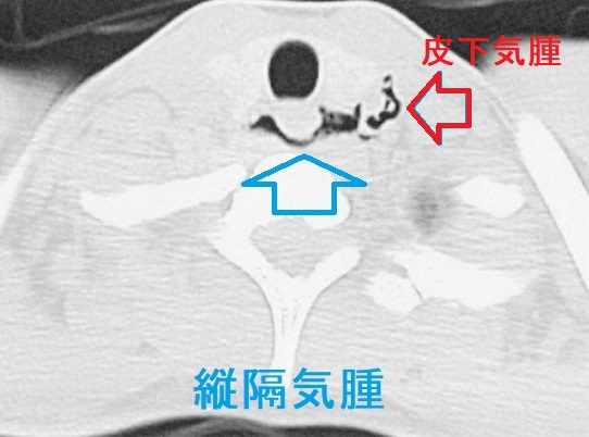 縦隔気腫 CT画像1 縦隔気腫 CT画像1