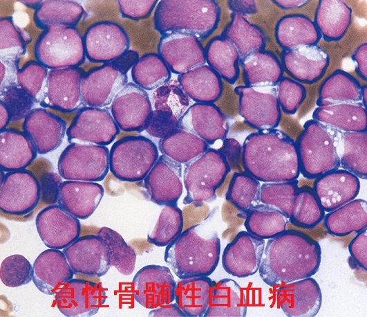 急性骨髄性白血病 急性骨髄性白血病