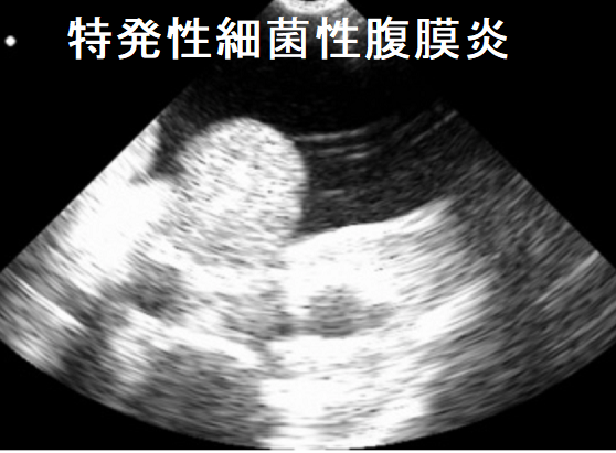 特発性細菌性腹膜炎 特発性細菌性腹膜炎
