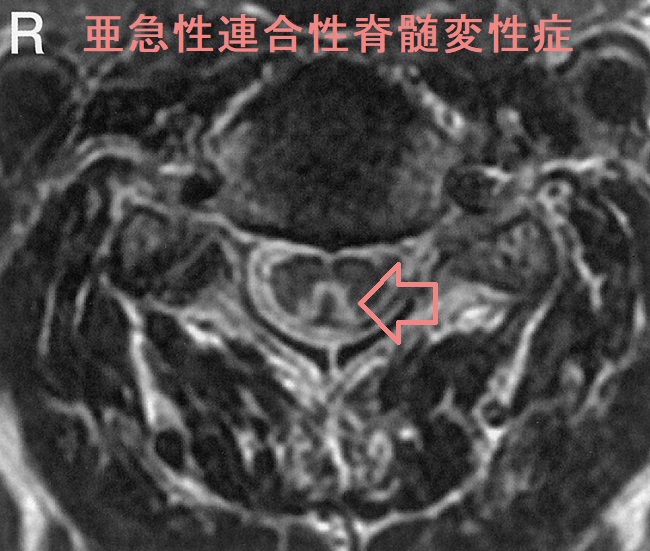 亜急性連合性脊髄変性症 頸椎MRI T2強調像 亜急性連合性脊髄変性症 頸椎MRI T2強調像