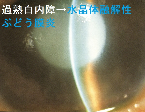 水晶体融解性ぶどう膜炎(水晶体起因性ぶどう膜炎) 水晶体融解性ぶどう膜炎(水晶体起因性ぶどう膜炎)