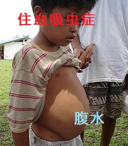 住血吸虫症 住血吸虫症
