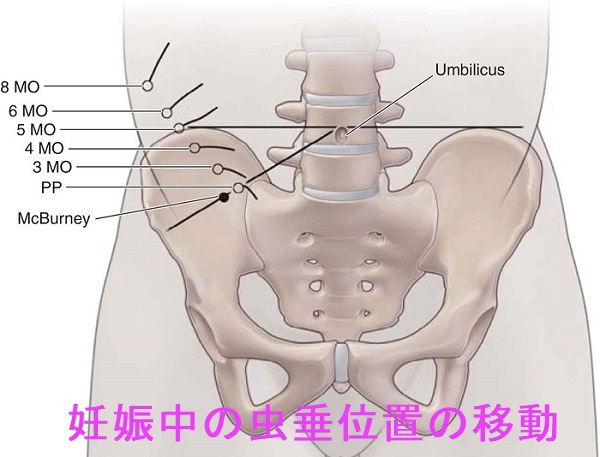 妊娠中の急性虫垂炎 妊娠中の急性虫垂炎