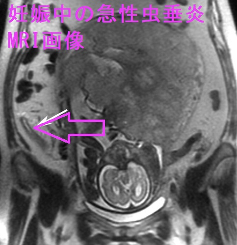 妊娠中の急性虫垂炎 MRI 脂肪抑制T2強調画像 妊娠中の急性虫垂炎 MRI 脂肪抑制T2強調画像