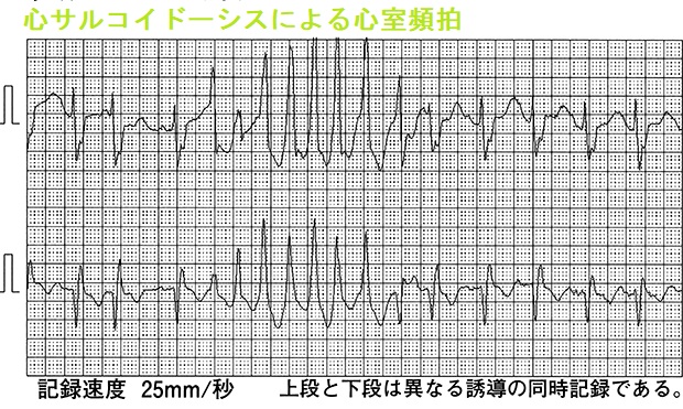 心サルコイドーシスによる心室頻拍1 心サルコイドーシスによる心室頻拍1