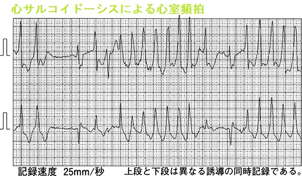 心サルコイドーシスによる心室頻拍2 心サルコイドーシスによる心室頻拍2