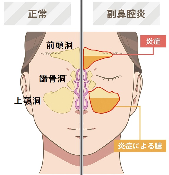 副鼻腔炎 副鼻腔炎