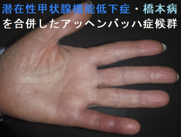 潜在性甲状腺機能低下症・橋本病を合併したアッヘンバッハ症候群 潜在性甲状腺機能低下症・橋本病を合併したアッヘンバッハ症候群