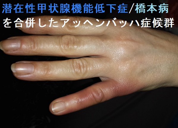 潜在性甲状腺機能低下症・橋本病を合併したアッヘンバッハ症候群2 潜在性甲状腺機能低下症・橋本病を合併したアッヘンバッハ症候群2
