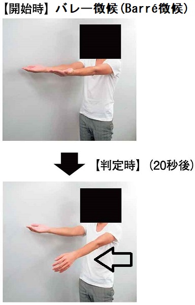 バレー徴候(Barré 徴候) バレー徴候(Barré 徴候)