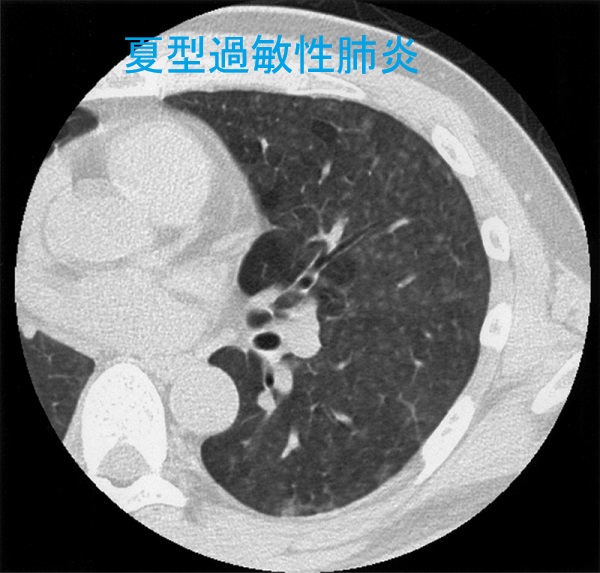 夏型過敏性肺炎 夏型過敏性肺炎