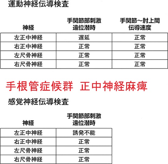手根管症候群 正中神経麻痺 末梢神経伝導検査 手根管症候群 正中神経麻痺 末梢神経伝導検査