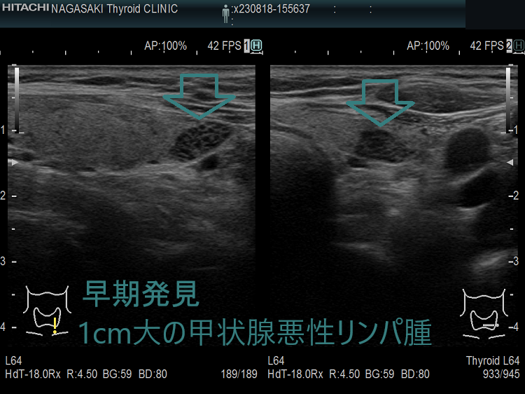 早期発見 1cm大の甲状腺悪性リンパ腫 早期発見 1cm大の甲状腺悪性リンパ腫