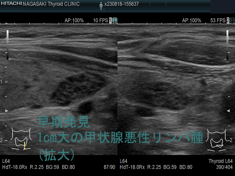 早期発見できた1cm大の甲状腺悪性リンパ腫(拡大) 早期発見できた1cm大の甲状腺悪性リンパ腫(拡大)