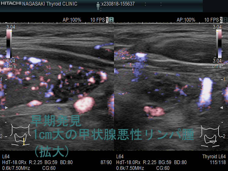 1cm大の甲状腺悪性リンパ腫(拡大)ドプラーモード 1cm大の甲状腺悪性リンパ腫(拡大)ドプラーモード