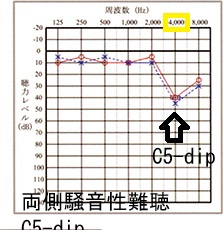 両側騒音性難聴 C5-dip 両側騒音性難聴 C5-dip