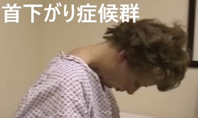 首下がり症候群 首下がり症候群