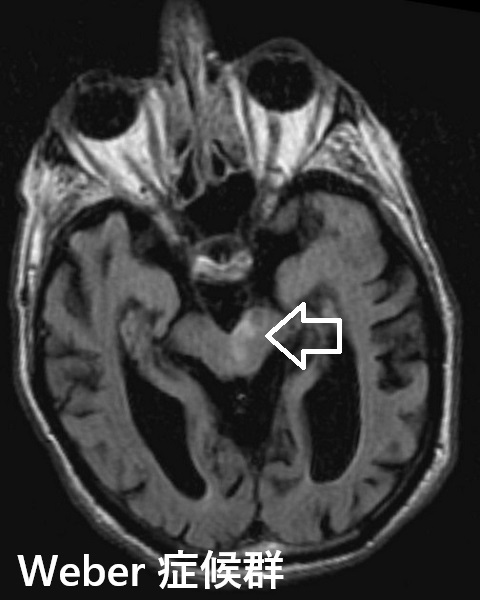 Weber 症候群 Weber 症候群