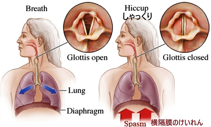 吃逆(しゃっくり)と甲状腺 吃逆(しゃっくり)と甲状腺