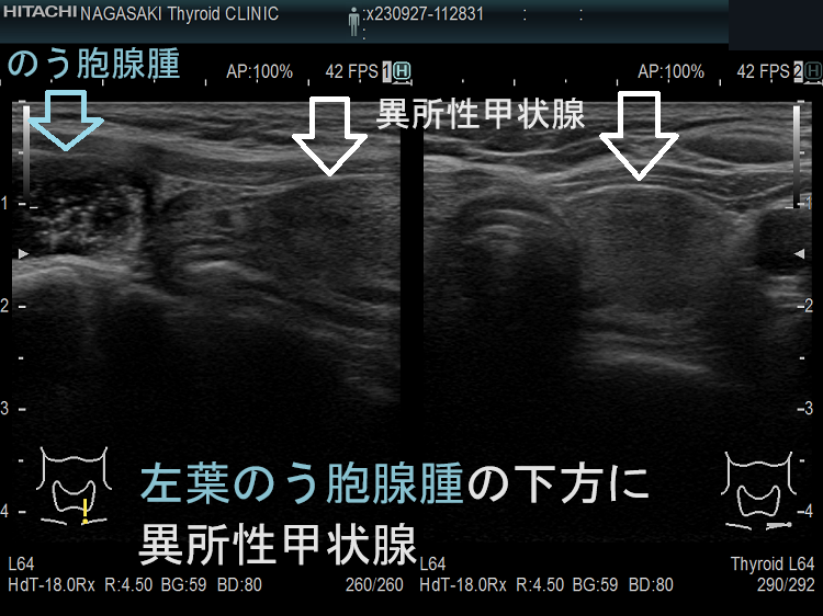 左葉のう胞腺腫の下方に異所性甲状腺(非腫瘍) 左葉のう胞腺腫の下方に異所性甲状腺(非腫瘍)