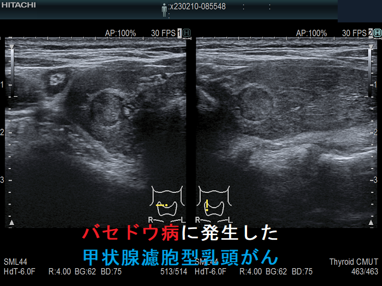 バセドウ病に発生した甲状腺濾胞型乳頭がん バセドウ病に発生した甲状腺濾胞型乳頭がん