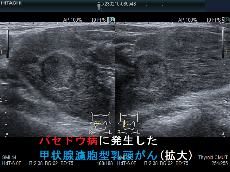 バセドウ病に発生した甲状腺濾胞型乳頭がん(拡大) バセドウ病に発生した甲状腺濾胞型乳頭がん(拡大)