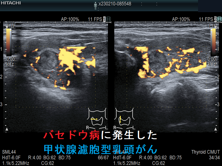 バセドウ病に発生した甲状腺濾胞型乳頭がん ドプラーモード バセドウ病に発生した甲状腺濾胞型乳頭がん ドプラーモード