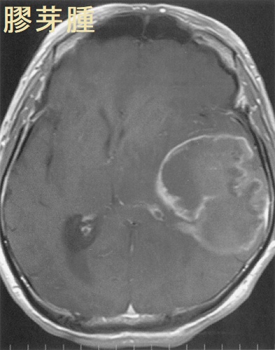膠芽腫 造影MRI T1 強調水平断像 膠芽腫 造影MRI T1 強調水平断像