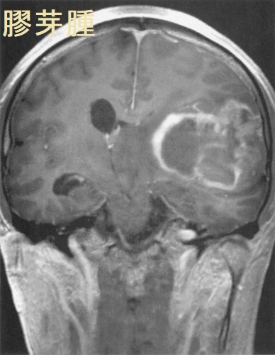 膠芽腫 造影MRI 冠状断像 膠芽腫 造影MRI 冠状断像