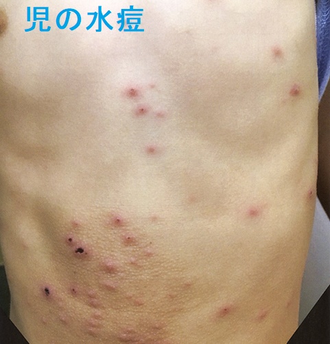 児の水痘 児の水痘