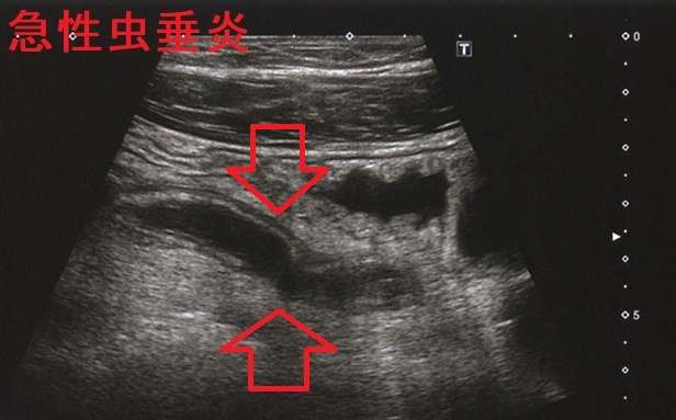 急性虫垂炎 腹部超音波像 急性虫垂炎 腹部超音波像