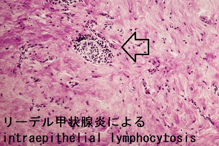 リーデル甲状腺炎によるintraepithelial lymphocytosis リーデル甲状腺炎によるintraepithelial lymphocytosis