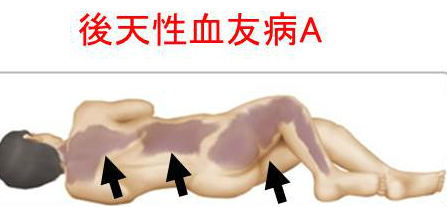 後天性血友病A 後天性血友病A
