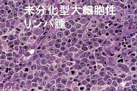 未分化大細胞性リンパ腫 未分化大細胞性リンパ腫