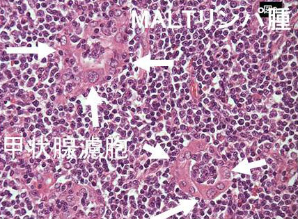 MALTリンパ腫のMALT ball MALTリンパ腫のMALT ball